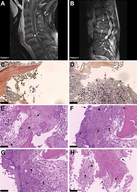 Intervertebral disc cell chondroptosis elicits neutrophil response in .